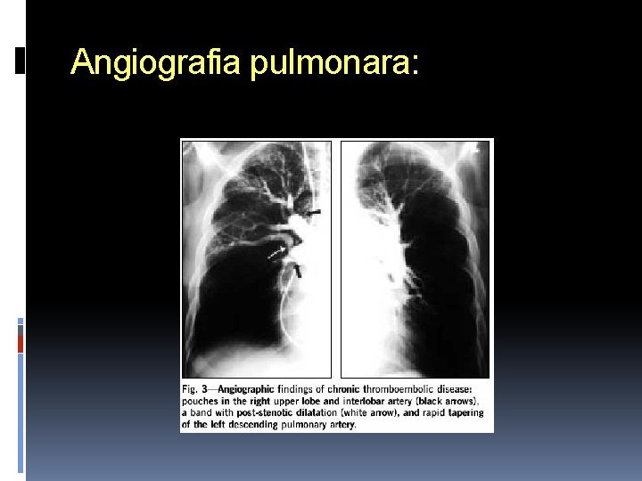 Angiografia pulmonara: 
