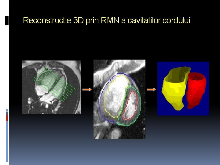 Reconstructie 3 D prin RMN a cavitatilor cordului 
