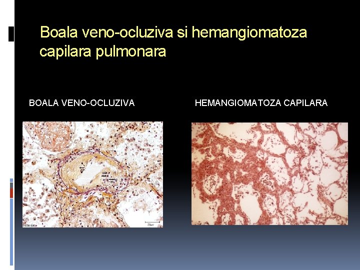 Boala veno-ocluziva si hemangiomatoza capilara pulmonara BOALA VENO-OCLUZIVA HEMANGIOMATOZA CAPILARA 