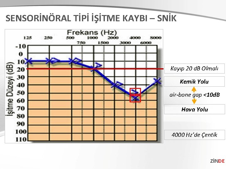 SENSORİNÖRAL TİPİ İŞİTME KAYBI – SNİK Kayıp 20 d. B Olmalı Kemik Yolu air-bone