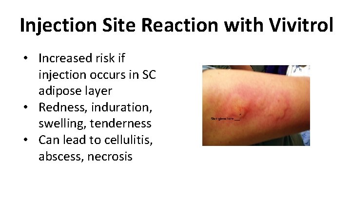 Injection Site Reaction with Vivitrol • Increased risk if injection occurs in SC adipose