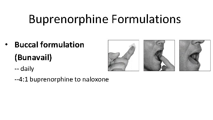 Buprenorphine Formulations • Buccal formulation (Bunavail) -- daily --4: 1 buprenorphine to naloxone 