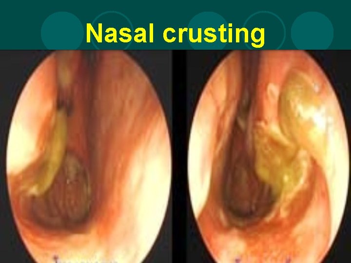 Nasal crusting 