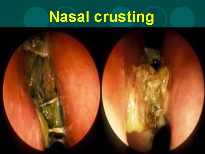 Nasal crusting 