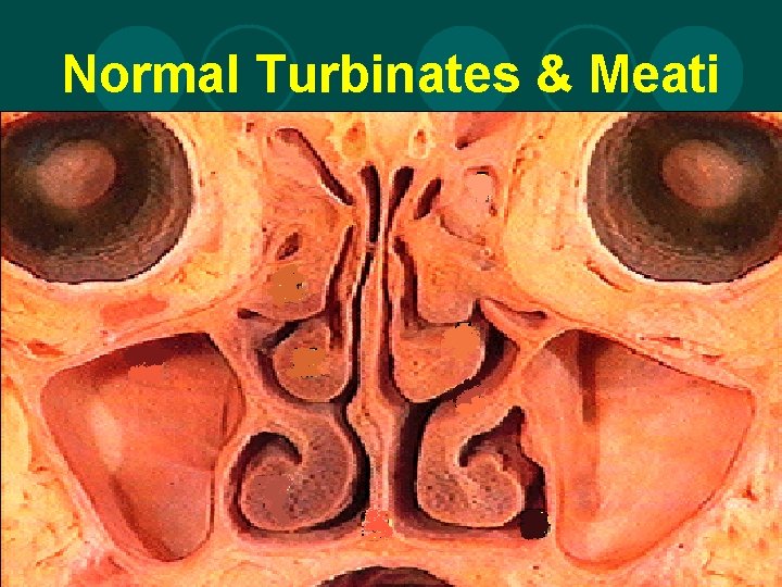 Normal Turbinates & Meati 