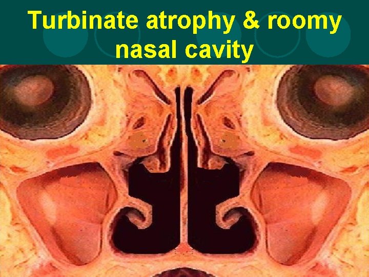 Turbinate atrophy & roomy nasal cavity 