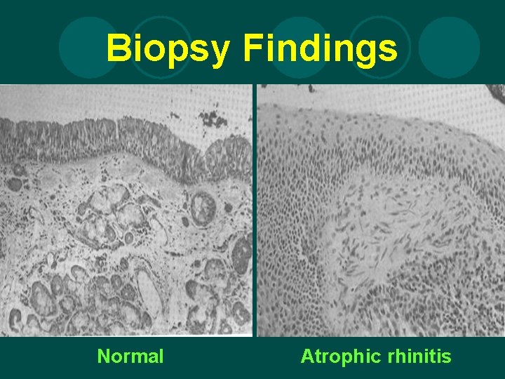 Biopsy Findings Normal Atrophic rhinitis 