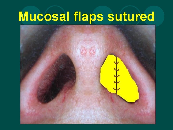 Mucosal flaps sutured 
