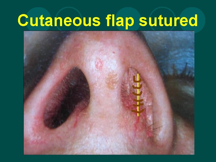 Cutaneous flap sutured 
