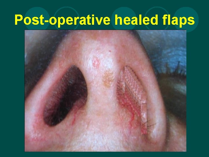 Post-operative healed flaps 