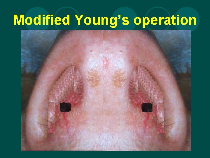 Modified Young’s operation 