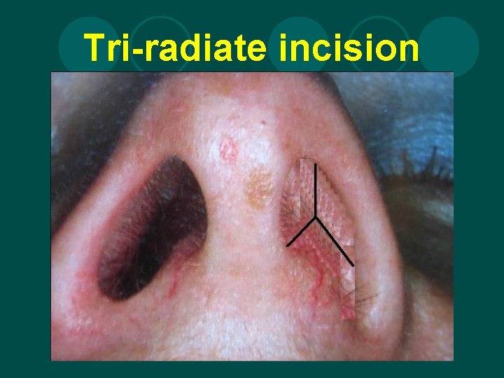 Tri-radiate incision 