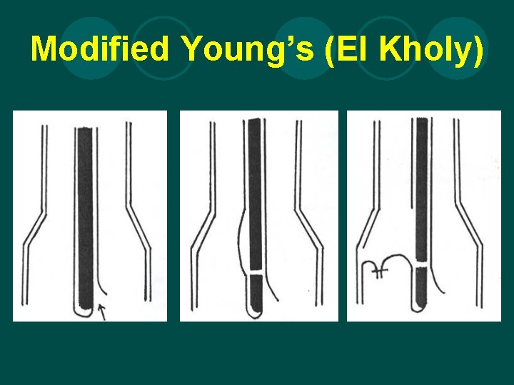 Modified Young’s (El Kholy) 