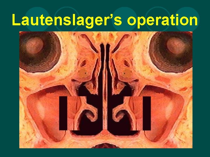 Lautenslager’s operation 