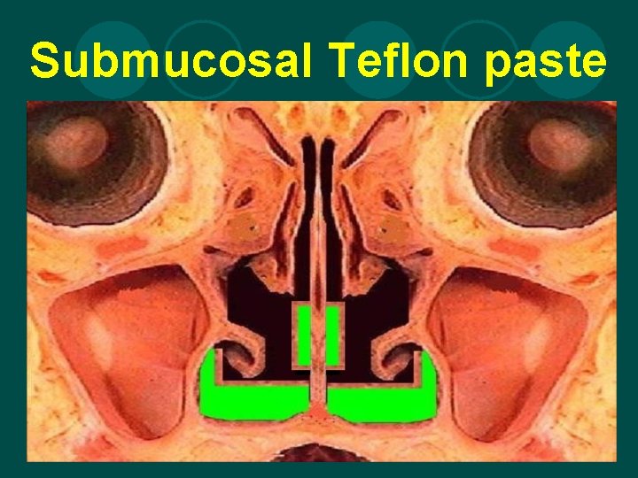 Submucosal Teflon paste 