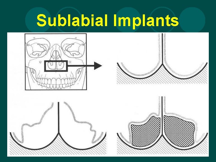 Sublabial Implants 