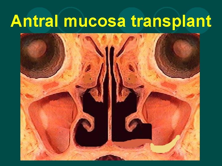 Antral mucosa transplant 