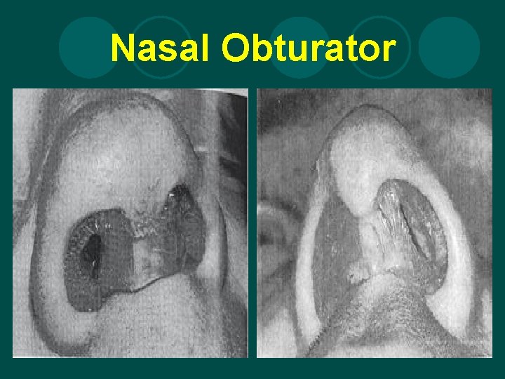 Nasal Obturator 