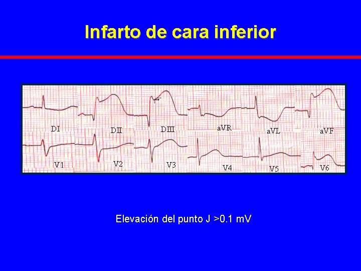 Infarto de cara inferior DI V 1 DIII a. VR a. VL a. VF