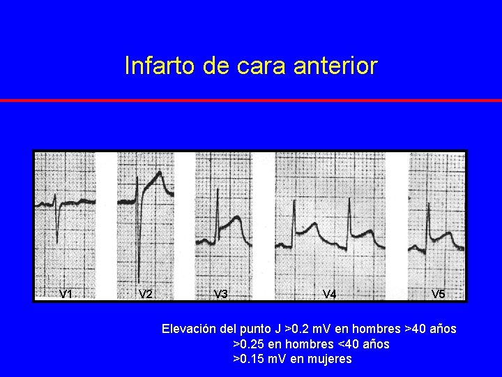 Infarto de cara anterior V 1 V 2 V 3 V 4 V 5