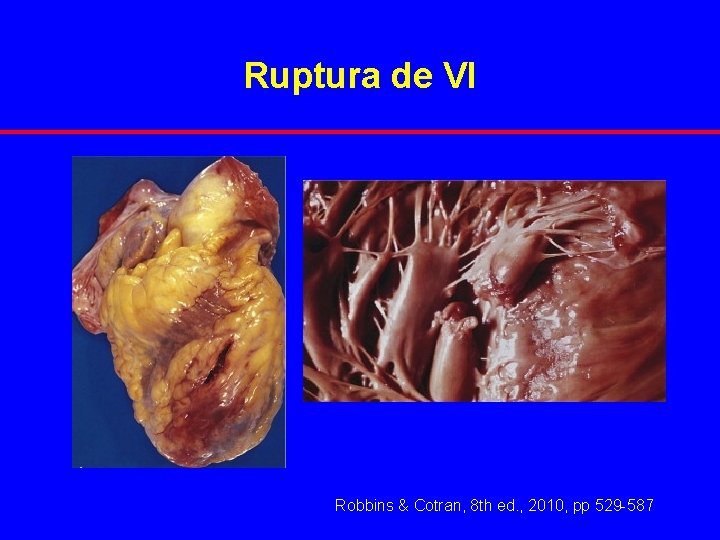 Ruptura de VI Robbins & Cotran, 8 th ed. , 2010, pp 529 -587