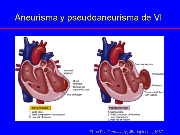 Aneurisma y pseudoaneurisma de VI Shah PK. Cardiology, JB Lippincott, 1987 