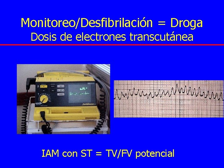 Monitoreo/Desfibrilación = Droga Dosis de electrones transcutánea IAM con ST = TV/FV potencial 