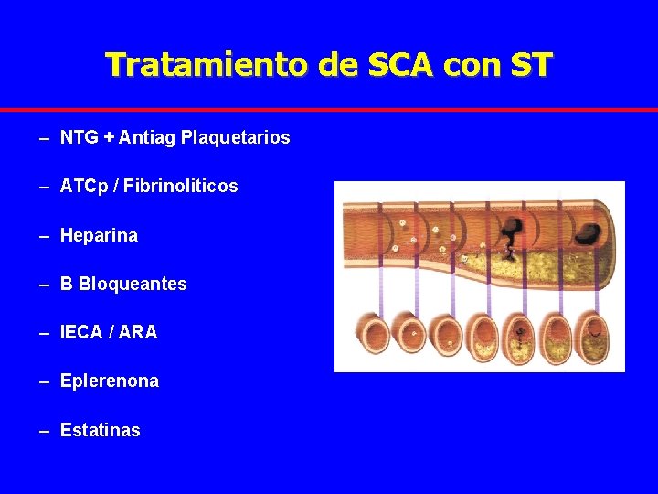 Tratamiento de SCA con ST – NTG + Antiag Plaquetarios – ATCp / Fibrinoliticos