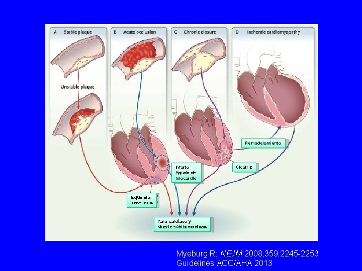 Remodelamiento Infarto Agudo de miocardio Cicatriz Isquemia transitoria Paro cardíaco y Muerte súbita cardíaca