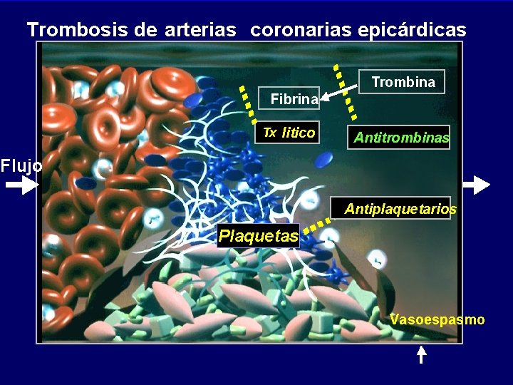 Trombosis de arterias coronarias epicárdicas Trombina Fibrina Tx litico Antitrombinas Flujo Antiplaquetarios Plaquetas Vasoespasmo