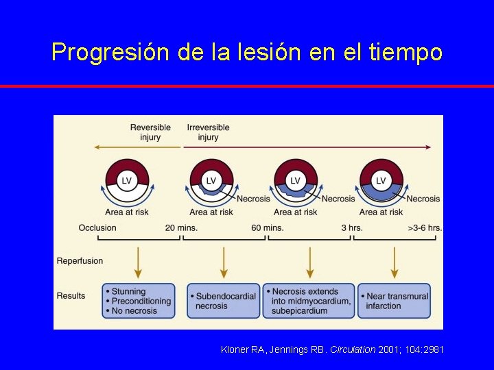 Progresión de la lesión en el tiempo Kloner RA, Jennings RB. Circulation 2001; 104: