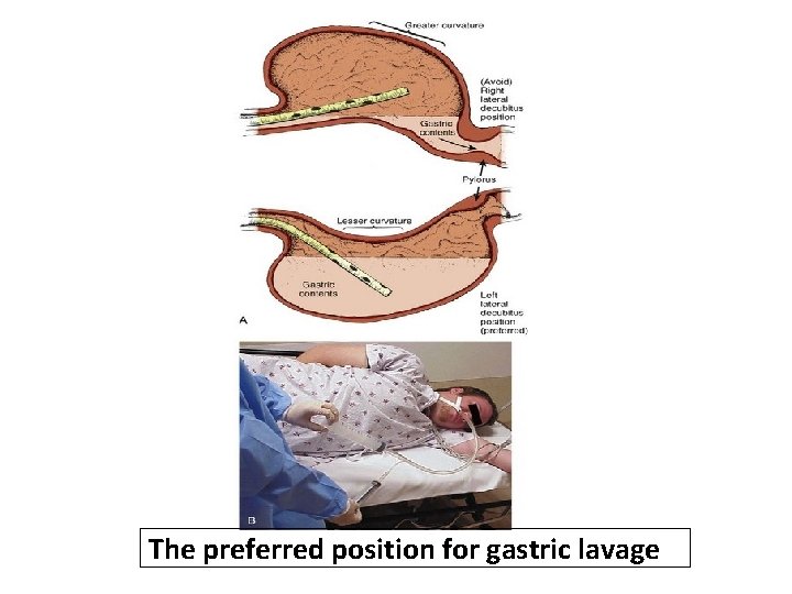 The preferred position for gastric lavage 