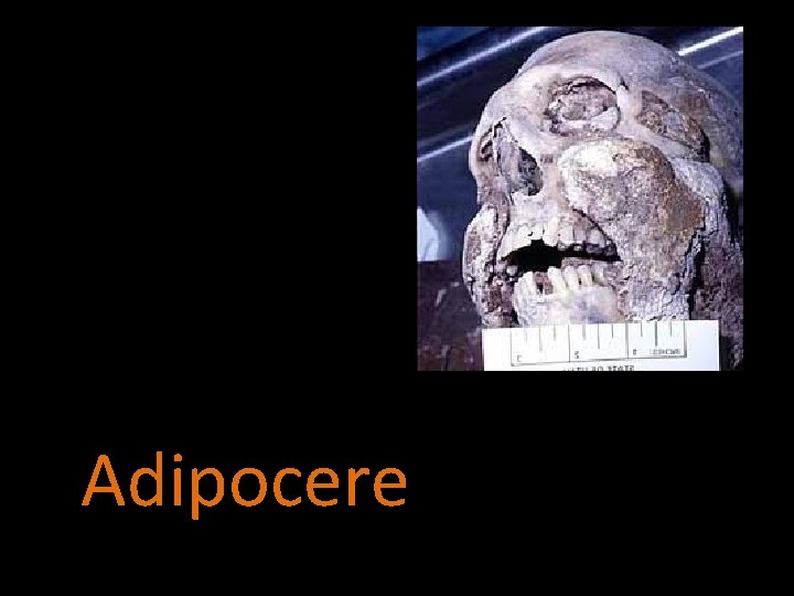 Adipocere 