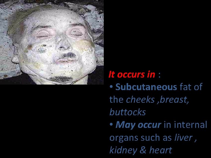 It occurs in : • Subcutaneous fat of the cheeks , breast, buttocks •