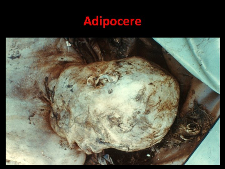 Adipocere 