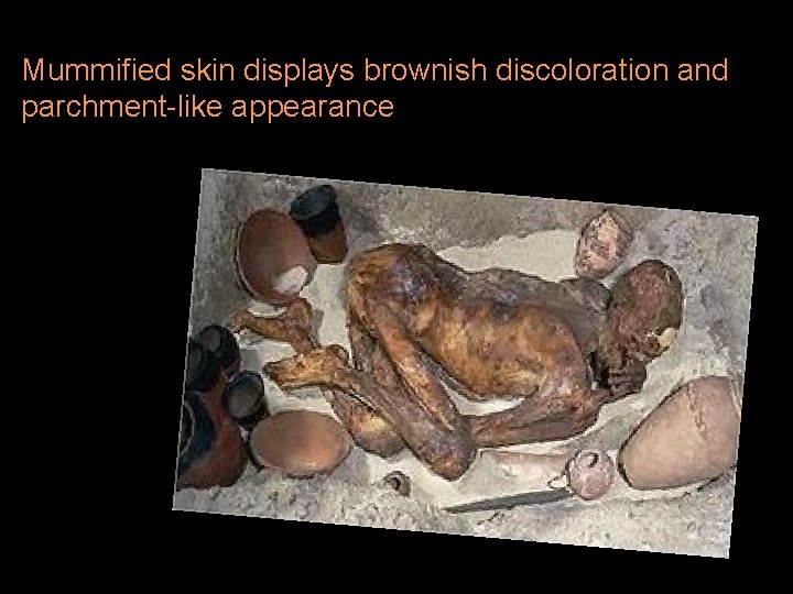 Mummified skin displays brownish discoloration and parchment-like appearance 