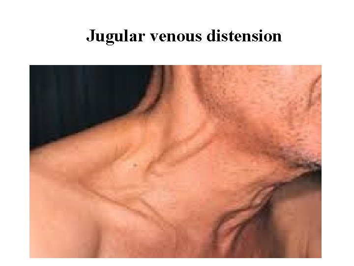 Jugular venous distension 