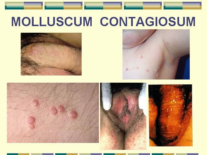 Molluscum contagios tratament, Condyloma molluscum contagiosum