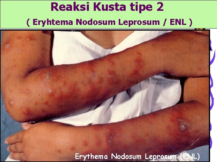 Reaksi Kusta tipe 2 ( Eryhtema Nodosum Leprosum / ENL ) Erythema Nodosum Leprosum