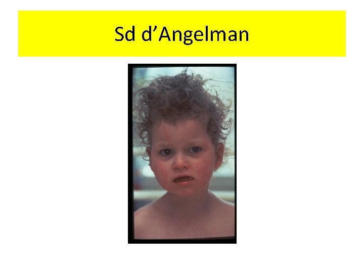 Sd d’Angelman 