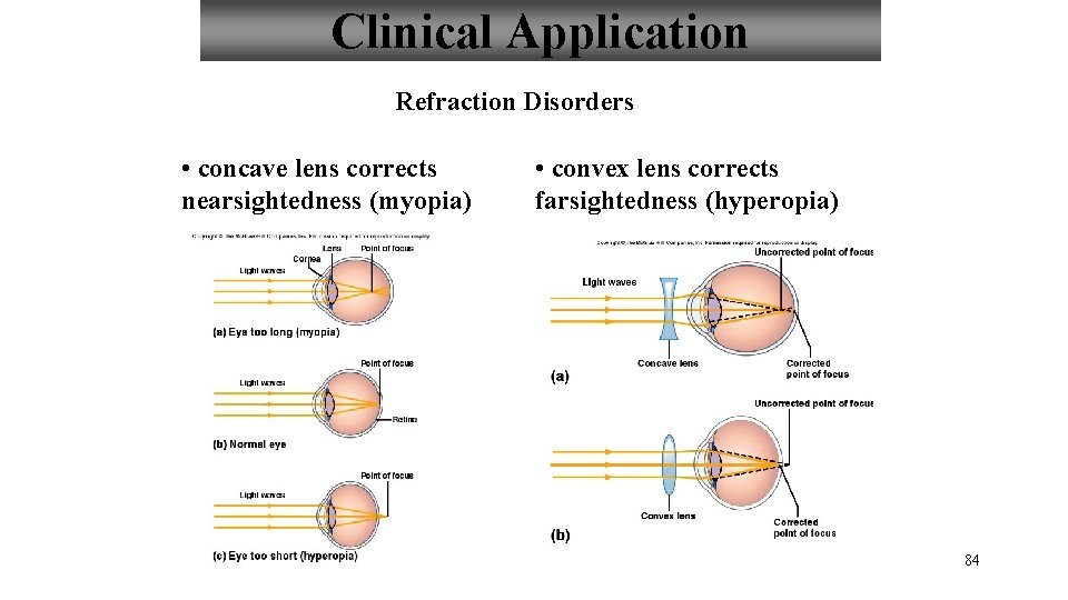 Clinical Application Refraction Disorders • concave lens corrects nearsightedness (myopia) • convex lens corrects