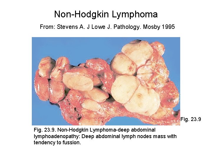 Non-Hodgkin Lymphoma From: Stevens A. J Lowe J. Pathology. Mosby 1995 Fig. 23. 9.