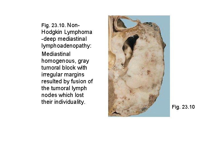 Fig. 23. 10. Non- Hodgkin Lymphoma -deep mediastinal lymphoadenopathy: Mediastinal homogenous, gray tumoral block