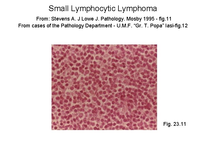 Small Lymphocytic Lymphoma From: Stevens A. J Lowe J. Pathology. Mosby 1995 - fig.