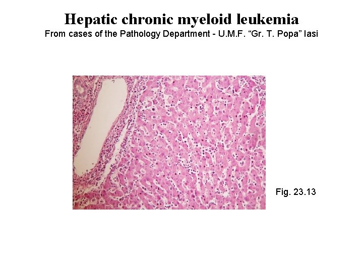 Hepatic chronic myeloid leukemia From cases of the Pathology Department - U. M. F.