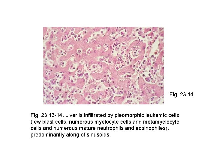 Fig. 23. 14 Fig. 23. 13 -14. Liver is infiltrated by pleomorphic leukemic cells