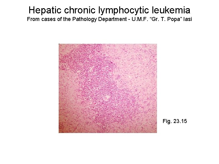 Hepatic chronic lymphocytic leukemia From cases of the Pathology Department - U. M. F.
