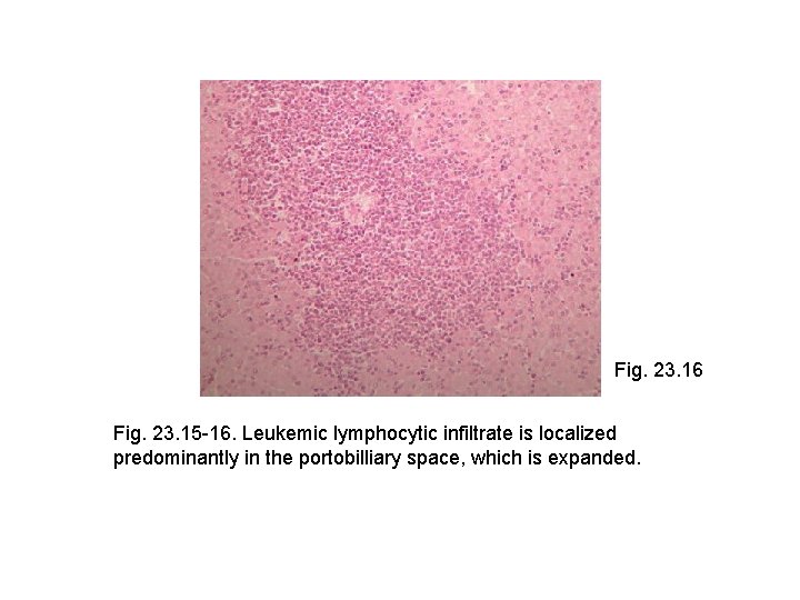 Fig. 23. 16 Fig. 23. 15 -16. Leukemic lymphocytic infiltrate is localized predominantly in