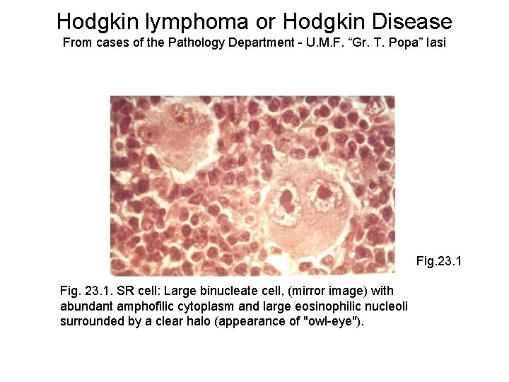 Hodgkin lymphoma or Hodgkin Disease From cases of the Pathology Department - U. M.