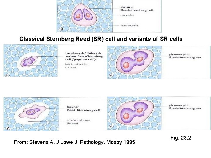 Classical Sternberg Reed (SR) cell and variants of SR cells From: Stevens A. J